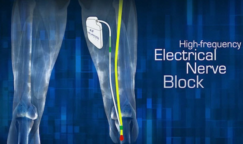 Medtronic Neurostimulator Devices Offer Hope for Chronic Pain [Video]