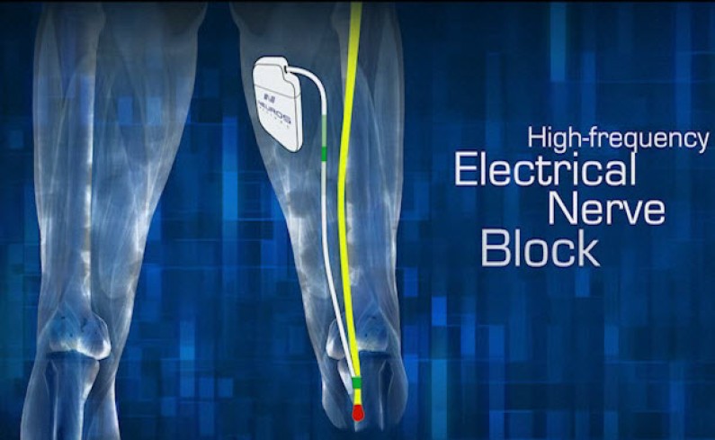 Medtronic Neurostimulator Devices Offer Hope for Chronic Pain [Video]